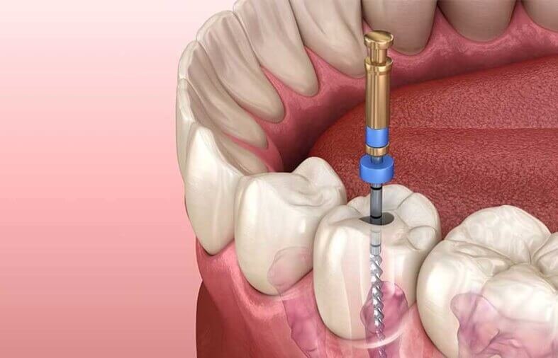 A Guide to Root Canal Recovery Time: What to Expect