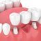 Restorative Dentistry: Solutions for Damaged or Missing Teeth