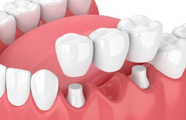 Restorative Dentistry: Solutions for Damaged or Missing Teeth