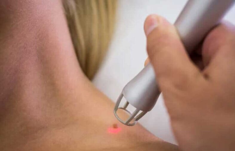 Top 4 Benefits of Choosing Laser Mole Removal Over Traditional Methods