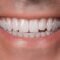 Top 6 Benefits of Choosing Front Dental Implants for Your Smile