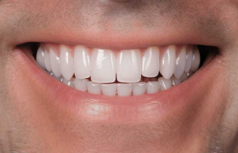 Top 6 Benefits of Choosing Front Dental Implants for Your Smile